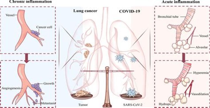 Can COVID-19 cause lung injury?