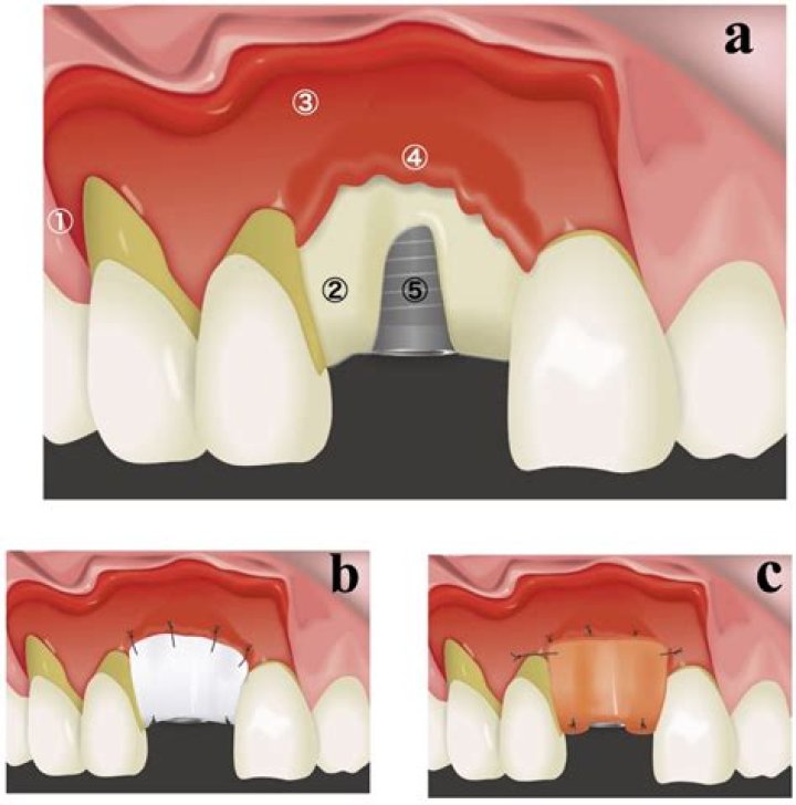 Can dental bone regeneration?