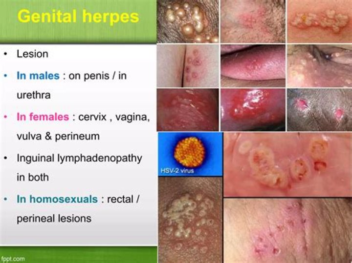 Can herpes cause chronic urethritis?