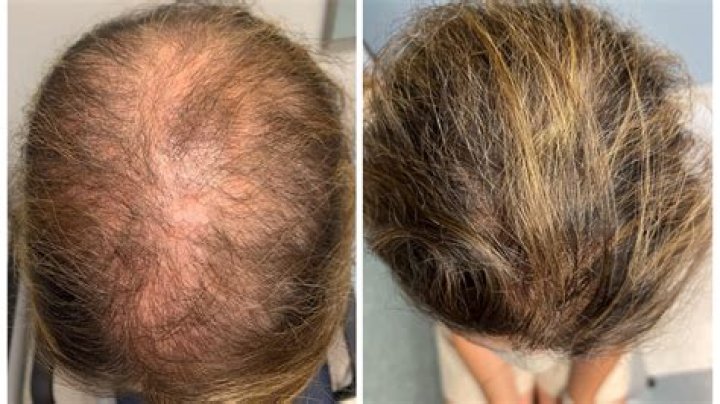 Can homeopathy cure hairloss?