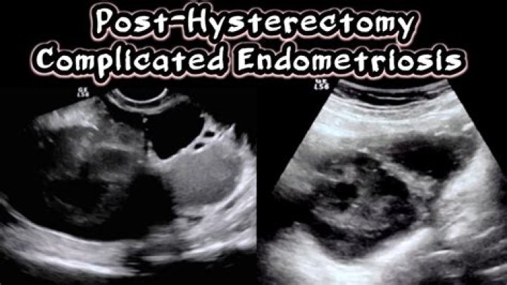 Can severe endometriosis show on ultrasound?