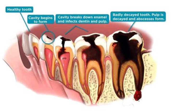 Can tooth decay cause an ear infection?