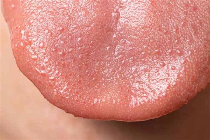 Do tongue bumps go away?