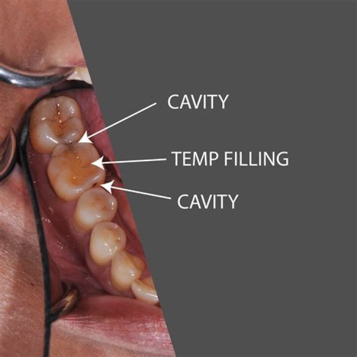 How long do dentist temporary fillings last?
