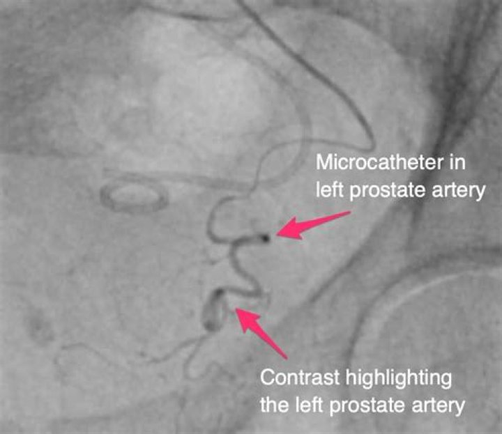 How long does it take for prostate artery embolization to work?