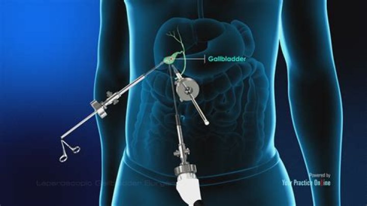 How long does laparoscopic gallbladder surgery take?