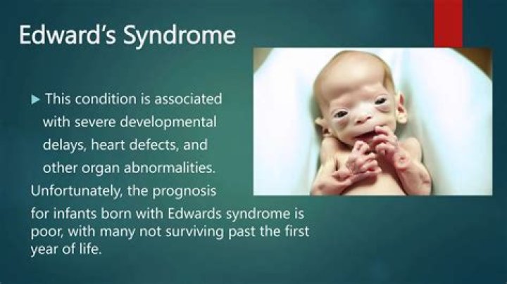 How long will someone with Edwards syndrome live?