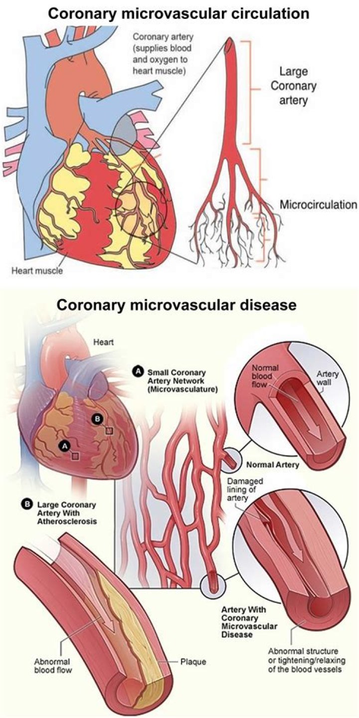 How serious is coronary microvascular disease?