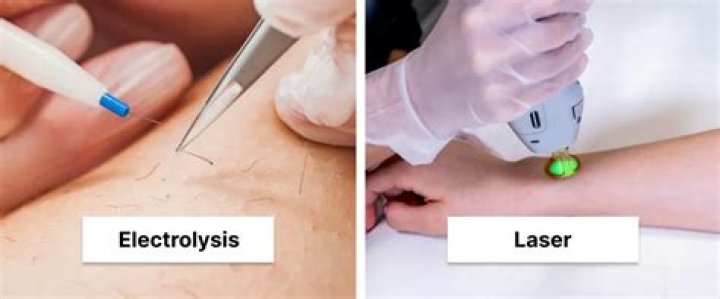 Is laser or electrolysis better for PCOS?