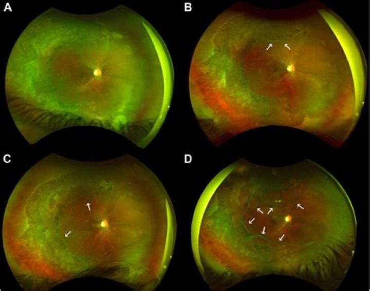 Is vitreous separation serious?