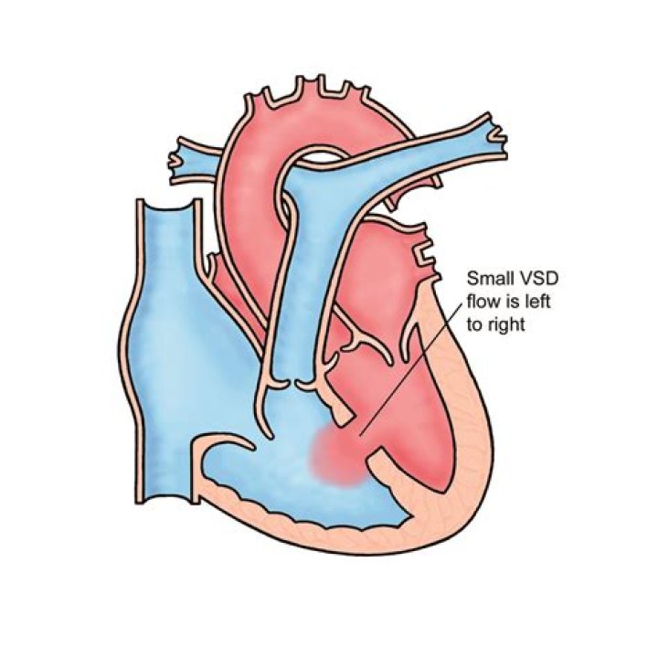 Is VSD the most common congenital heart defect?