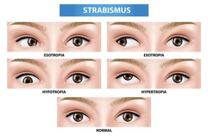 What causes of strabismus?