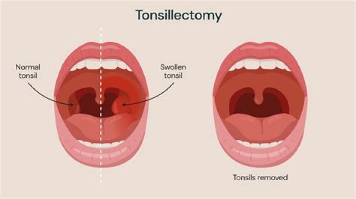 What does a swollen lingual tonsil mean?