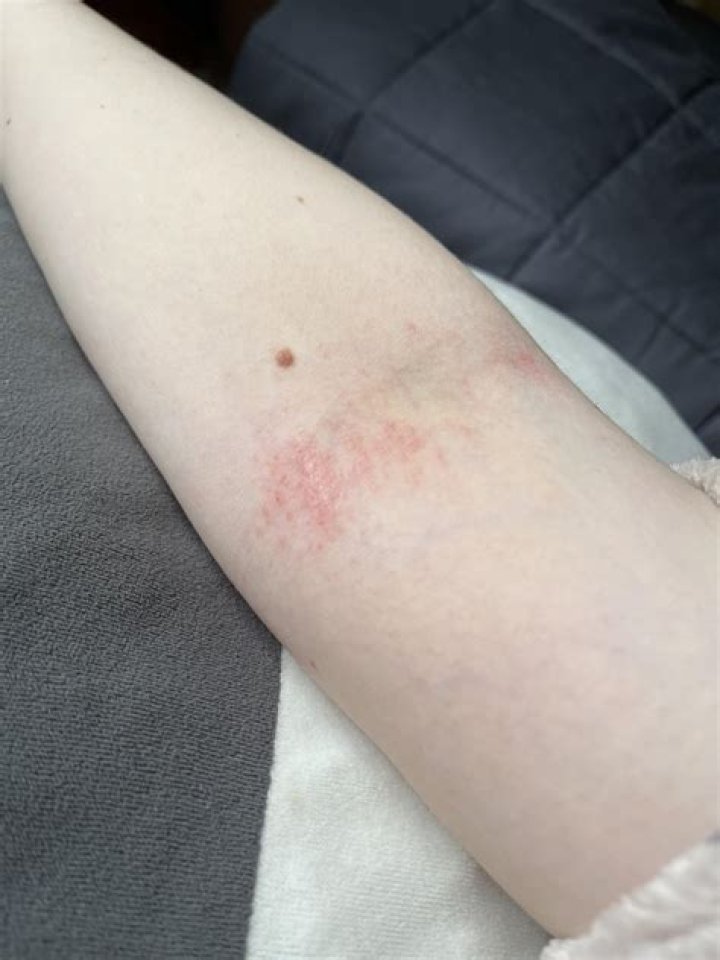 What does eczema look like on elbow?