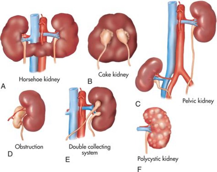 What happens if both kidneys are infected?
