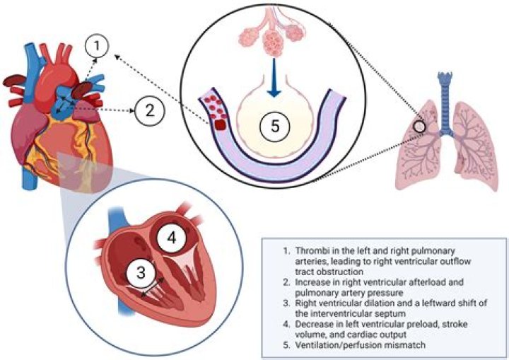 What is a pulmonary artery fistula?