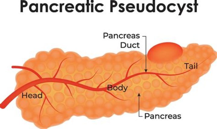 What is considered a large pseudocyst?