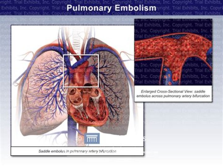 What is not one of the symptoms of a pulmonary embolism?