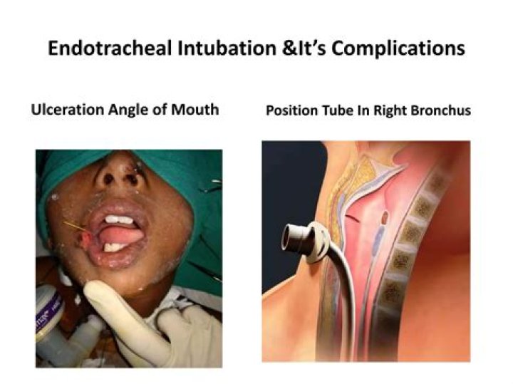 What is the most dangerous complication of intubation?