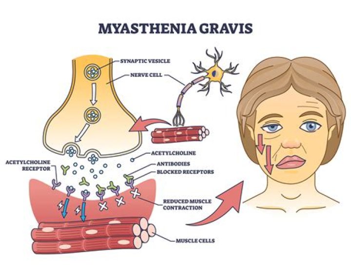 What is the treatment for myasthenic syndrome?