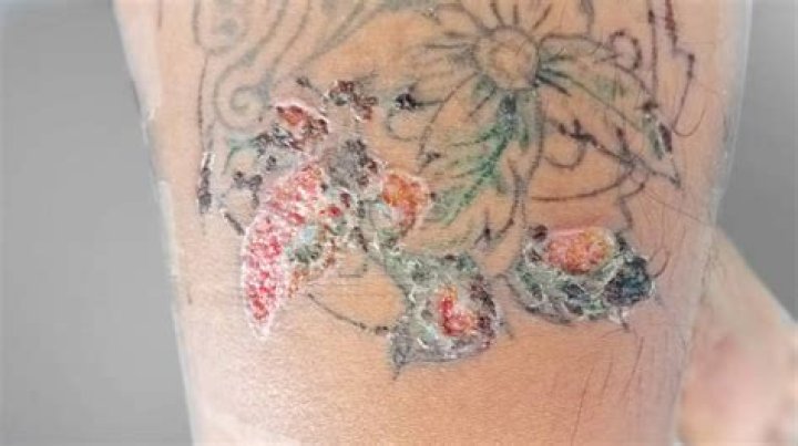 Why does plasma leak from tattoos?